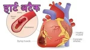 हार्ट अटैक के कारण,क्यों नहीं हो पा रहा बचाव,जानने के लिए ध्यान दीजिए !